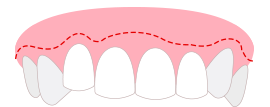 비대칭한 잇몸라인