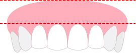 비대칭한 잇몸라인