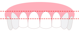 비대칭한 잇몸라인
